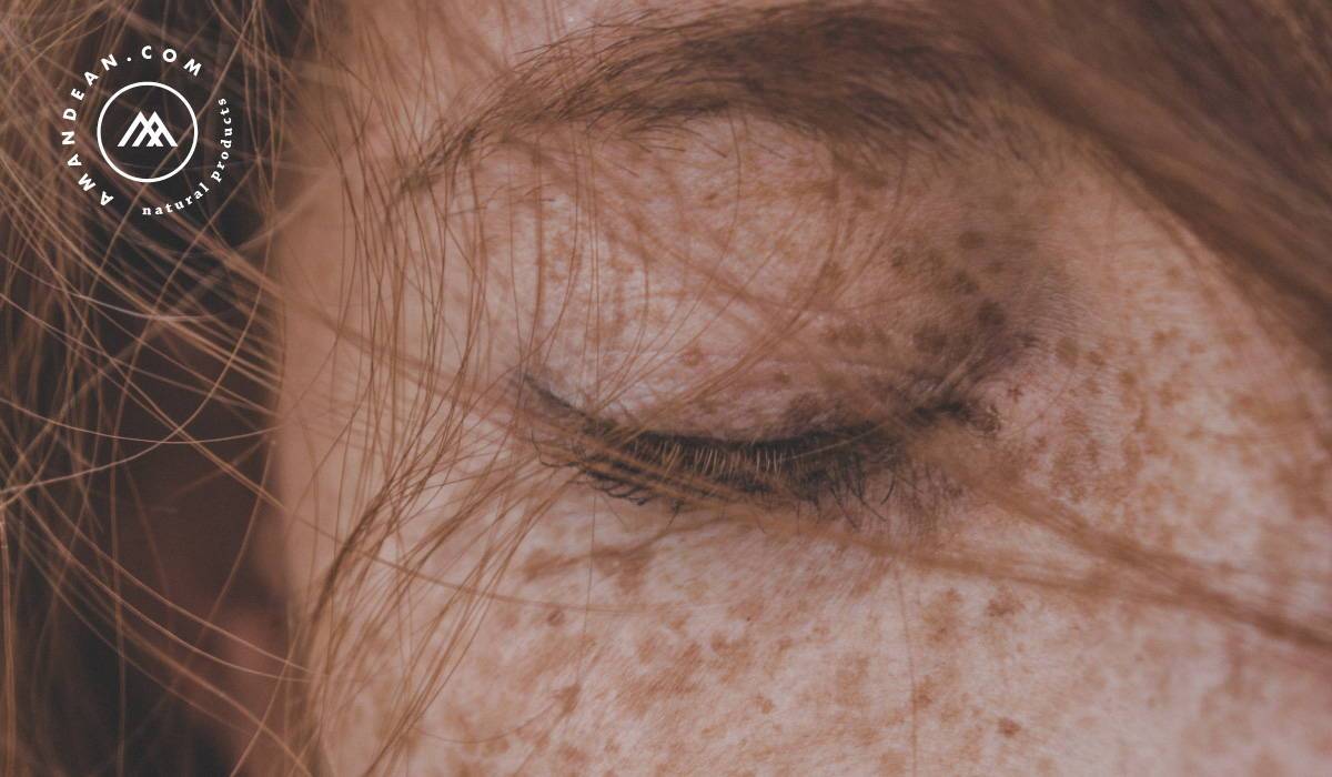 Hyperpigmentation vs. Melasma. What's the difference and how to manage them